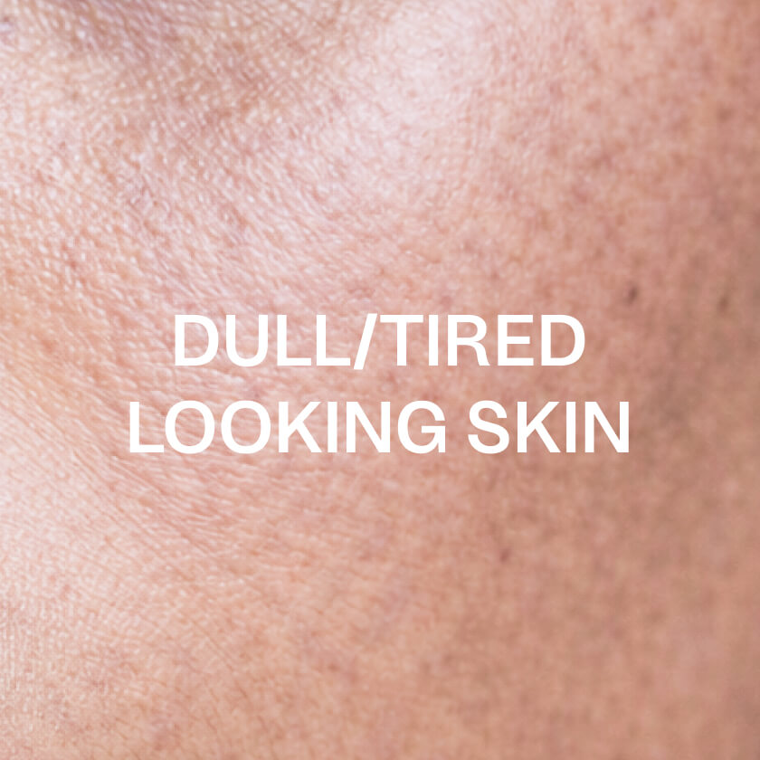 Väsynyt tai samea iho