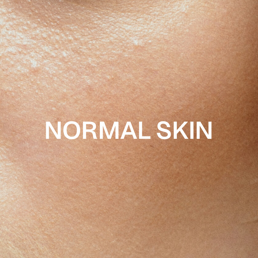 Normaali iho