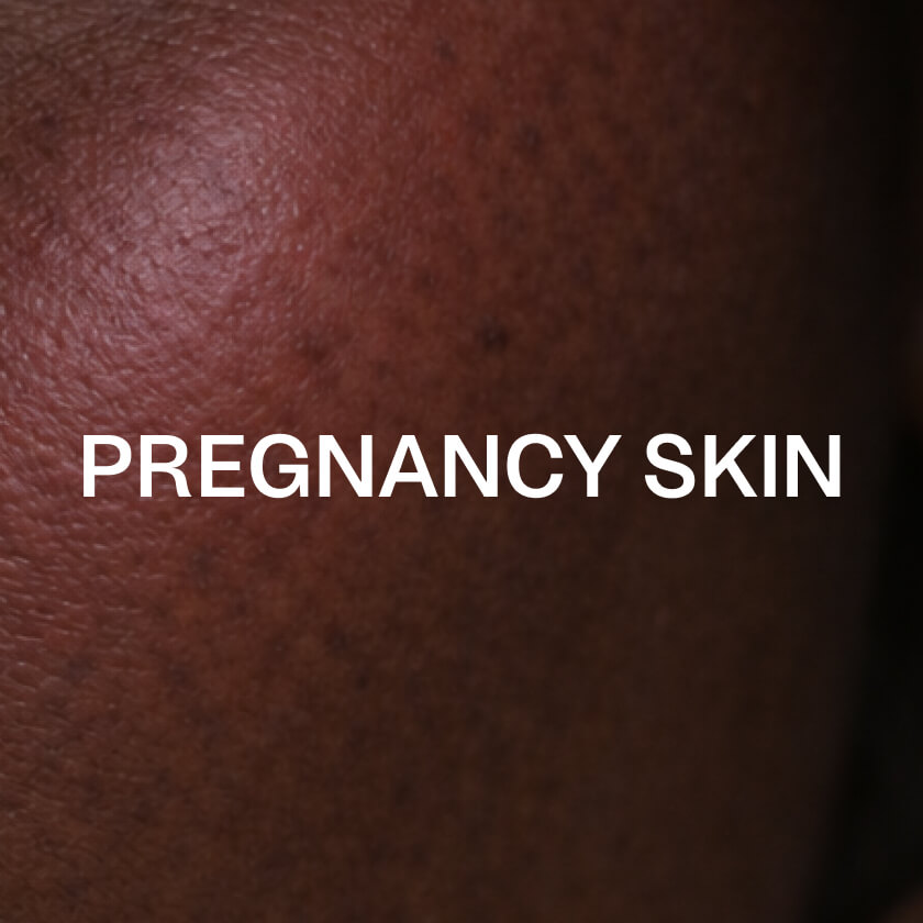 Raskauden aikainen iho