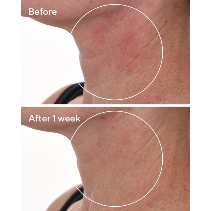 Murad Cellular Hydration Repair Serum 30 ml korjaava seerumi vähentää näkyvästi punoitusta kaulan iholla viikossa.