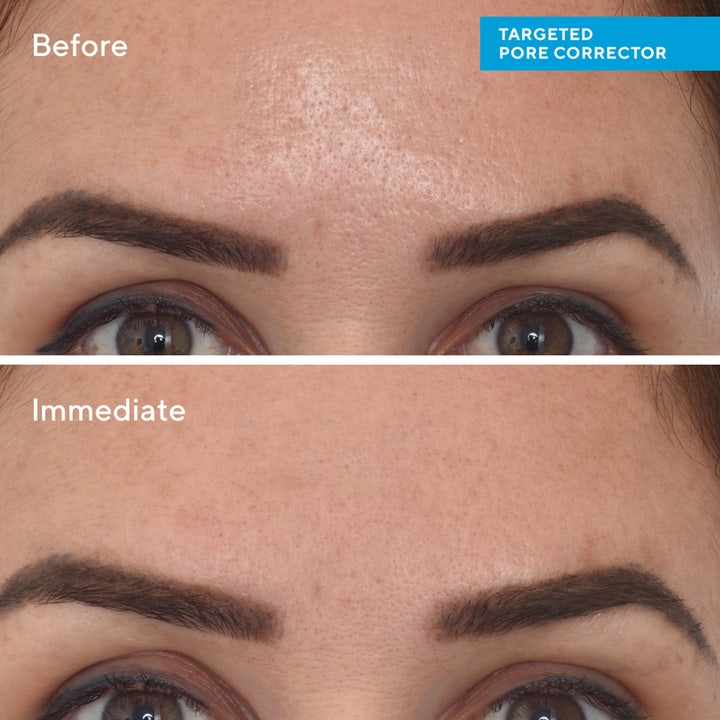 Murad Targeted Pore Corrector 15 ml supistava täsmähoito näyttää ennen ja jälkeen vertailun otsan ihohuokosista