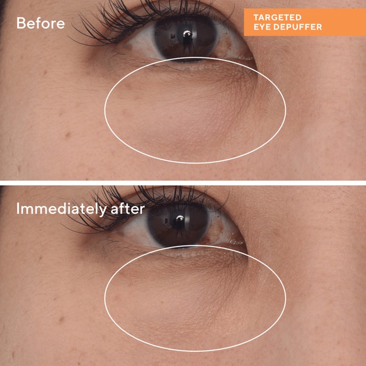 Murad Targeted Eye Depuffer 15 ml silmänympärysvoide ennen ja jälkeen tulokset laskevat turvotusta.