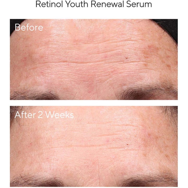 Murad Resurgence Retinol Youth Renewal Serum 30 ml silottava seerumi ennen ja jälkeen kuvat otsarypyistä 2 viikossa