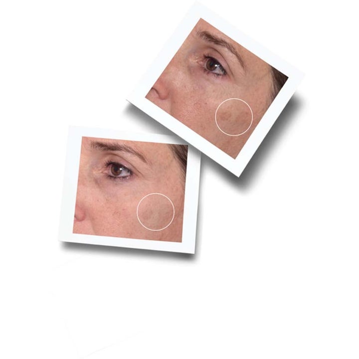 Murad Spot Corrector 80 ml pigmenttimuutosten hoito vaalentaa iholäiskiä ennen ja jälkeen kuvissa.