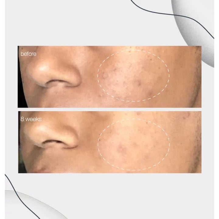 Dermalogica PowerBright Dark Spot Serum Duo niasiiniamidi häivyttää pigmenttiläiskiä 8 viikon ennen ja jälkeen kuvassa.