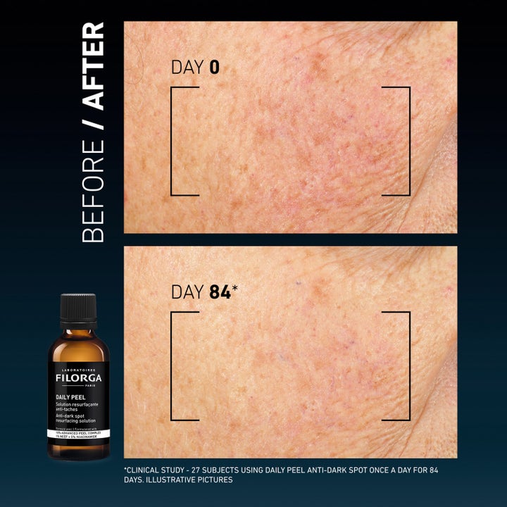 Filorga Clinical Home Peel Dark Spot 50 ml kuorinta vaalentaa pigmenttiläiskiä ennen ja jälkeen tuloskuvissa.