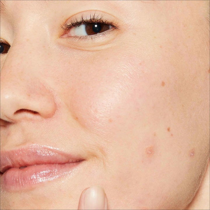 Dermalogica Deep Acne Liquid Patch 15 ml seerumi hoitaa epäpuhtauksia lähikuvassa näkyvällä akneen taipuvaisella iholla.