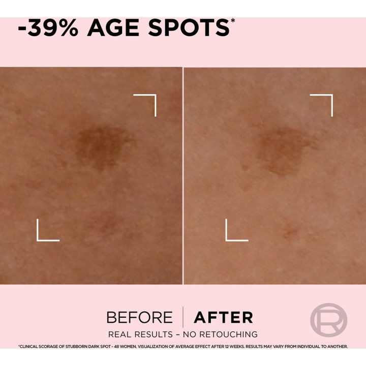 L'Oréal Paris Age Perfect 30 ml seerumi vähentää pigmenttiläiskiä ennen ja jälkeen tuloskuvassa.