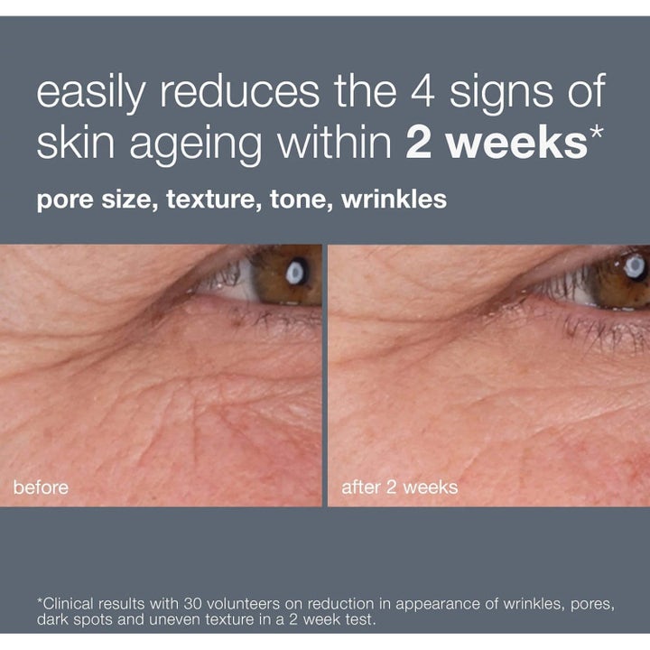 Dermalogica Retinol Renewal Duo 2 x 30 ml seerumi vähentää ryppyjä ennen ja jälkeen -kuvassa 2 viikon jälkeen.