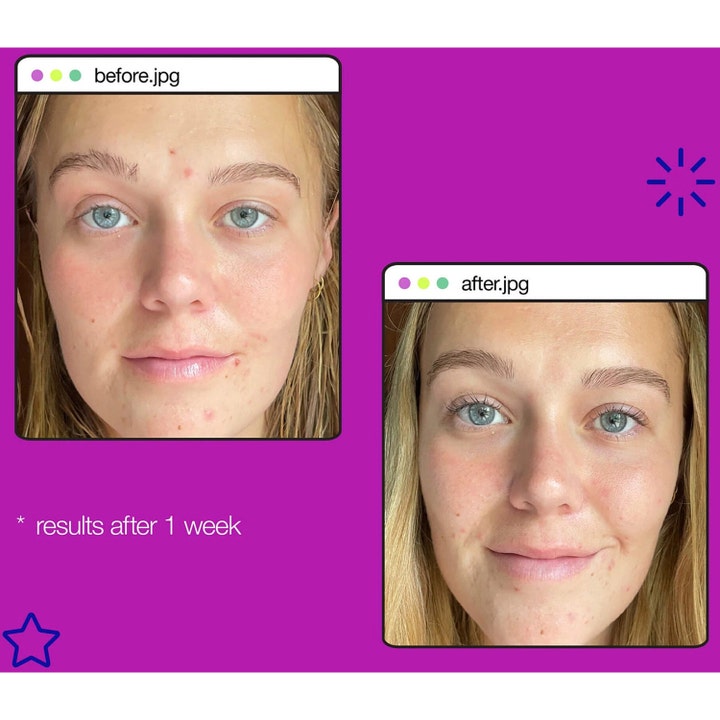 Dermalogica Post-Breakout Fix 15 ml seerumi finnien jälkiin näyttää tulokset ennen ja jälkeen viikon käytön.