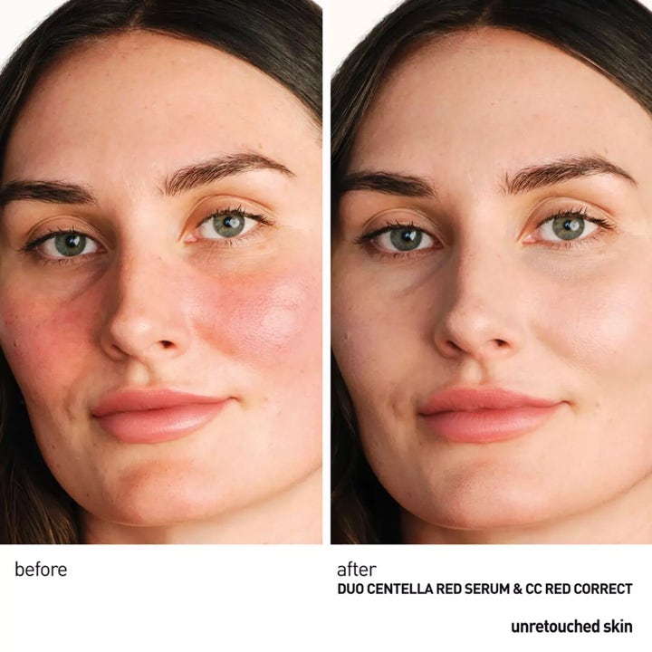 Erborian Centella Red Serum 30 ml rauhoittava seerumi ennen ja jälkeen vertailu vähentämässä kasvojen punoitusta