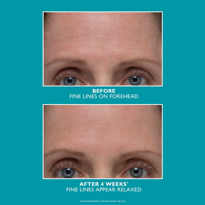 Peter Thomas Roth Peptide Skinjection 30 ml silottava seerumi näyttää ennen ja jälkeen tulokset otsan juonteille.