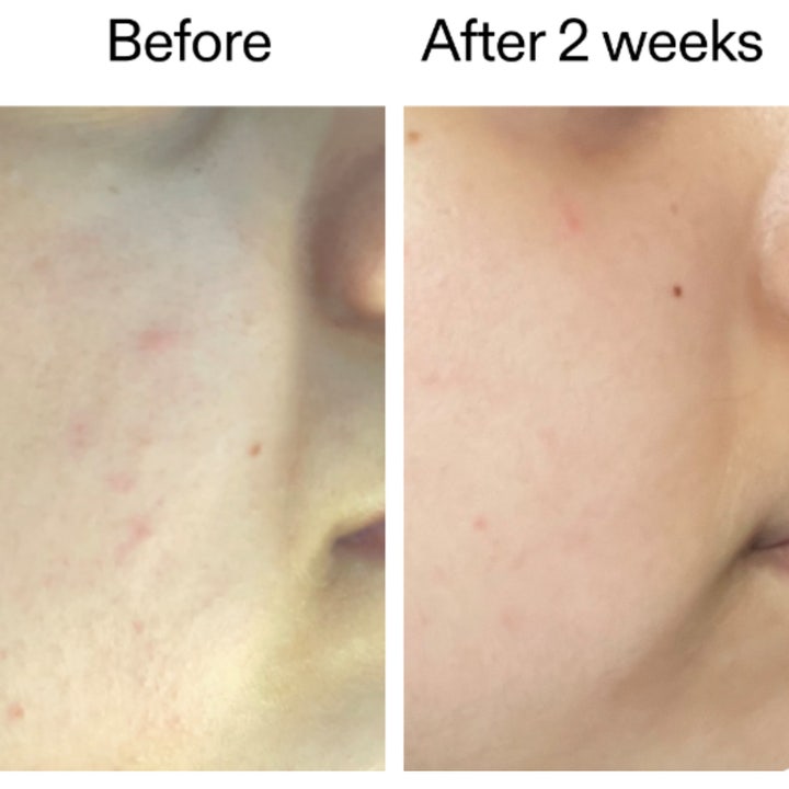 The INKEY List 360 Skin Clearing Serum 30 ml puhdistava kasvoseerumi Before ja After 2 weeks tulos iholla