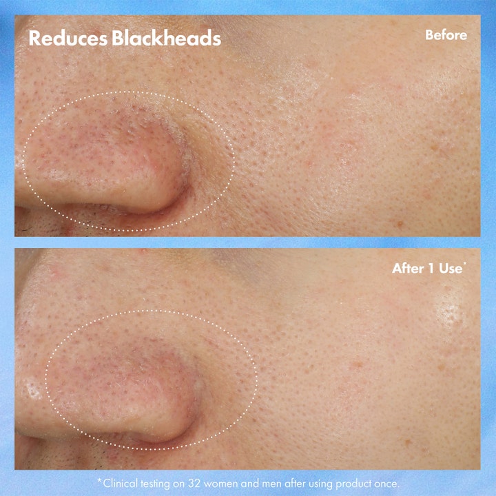 Origins Clear Improvement Blackhead Clearing Mask-To-Scrub 75 ml ennen ja jälkeen kuva vähentää mustapäitä After 1 Use