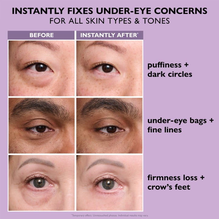 Peter Thomas Roth Instant FIRMx Eye 20 ml silmänympärysvoide ennen ja jälkeen kuvat silmäpusseista ja juonteista