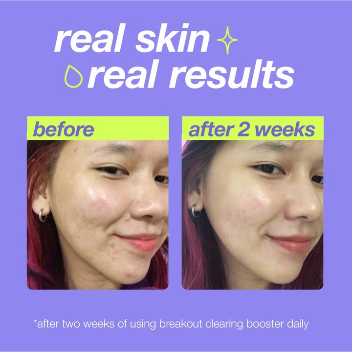 Dermalogica Clear Start Breakout Clearing Booster 30 ml seerumi poistaa epäpuhtaudet ja näyttää tulokset 2 viikon jälkeen.