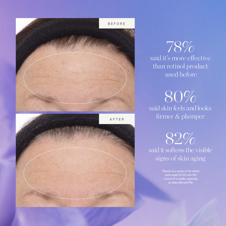 KORA Organics Plant Stem Cell Retinol Alternative Serum 30 ml silottaa juonteita ennen ja jälkeen vertailukuvassa.