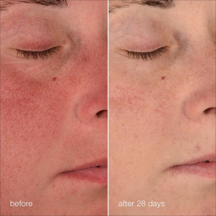 Dermalogica Stabilizing Repair Cream Duo kasvovoide rauhoittaa ihoa ja vähentää punoitusta 28 päivän käytön jälkeen