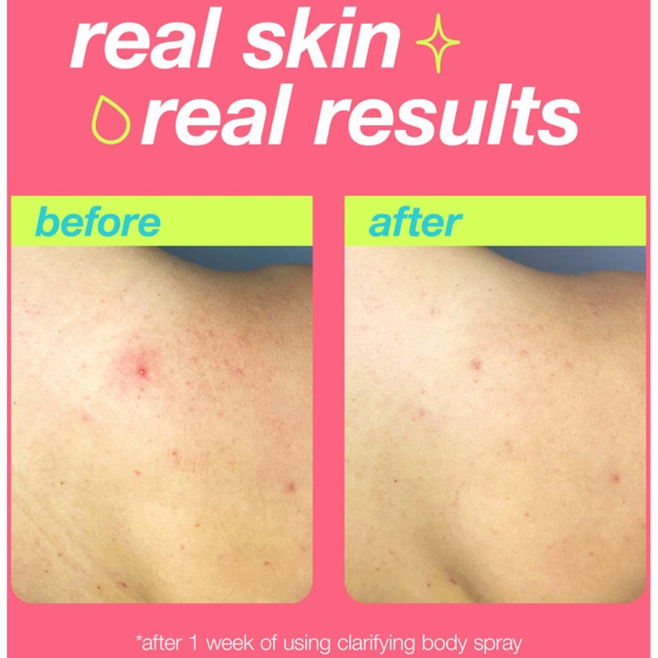 Dermalogica Clarifying Body Spray 177 ml vartalosuihke epäpuhtauksia vastaan näyttää iholla ennen ja jälkeen tulokset
