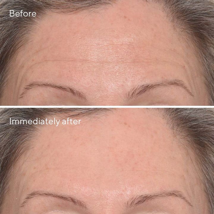 Murad Resurgence Targeted Wrinkle Corrector 15 ml ryppyjä silottava seerumi silottaa otsan juonteet välittömästi.