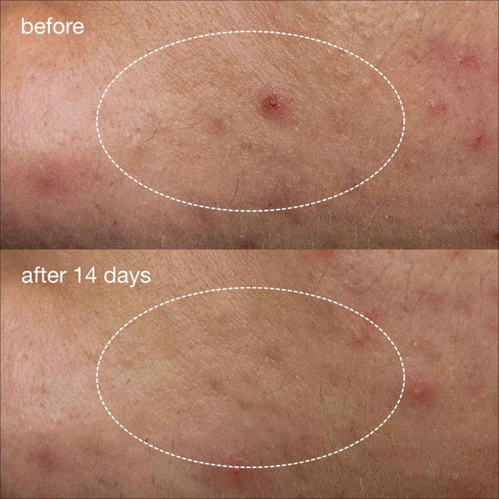 Dermalogica Deep Acne Liquid Patch Duo 2x15 ml niasiiniamidihoito näyttää ihon puhdistumisen 14 päivän jälkeen.