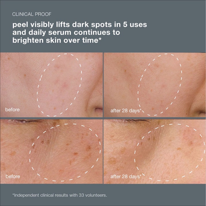 Dermalogica PowerBright Dark Spot System kirkastava setti vaalentaa pigmenttiläiskiä ennen ja jälkeen vertailukuvissa.