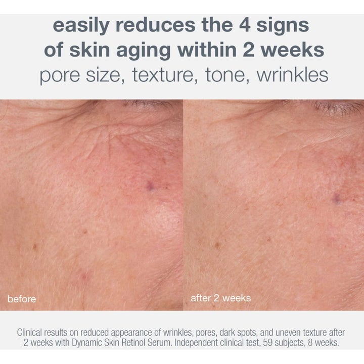 Dermalogica Skin Aging Solutions Duo näyttää ennen ja jälkeen kuvat juonteiden ja ihon rakenteen tasoittumisesta.