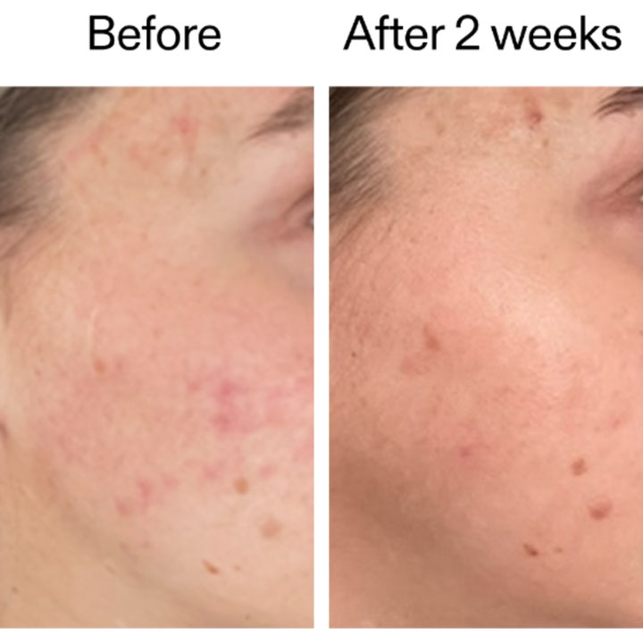 The INKEY List 360 Skin Clearing Serum 30 ml kirkastava seerumi ennen ja jälkeen 2 viikon käytön tulos