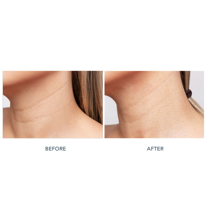 FAQ Swiss FAQ™ 211 LED Neck & Décolleté Mask 1 kpl silottaa kaulan juonteita ennen ja jälkeen -vertailukuvassa