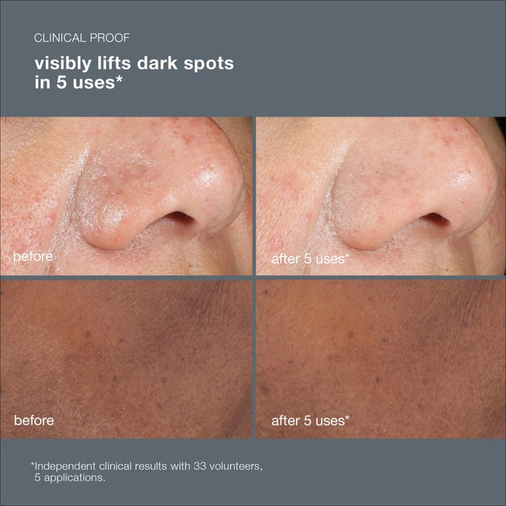 Dermalogica PowerBright Dark Spot Peel 50 ml kuorinta häivyttää pigmenttiläiskiä ennen ja jälkeen kuvissa.