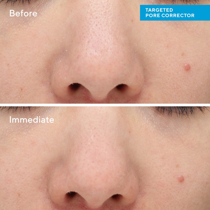 Murad Targeted Pore Corrector 15 ml supistava täsmähoito häivyttää ihohuokosia välittömästi ennen ja jälkeen -kuvassa.