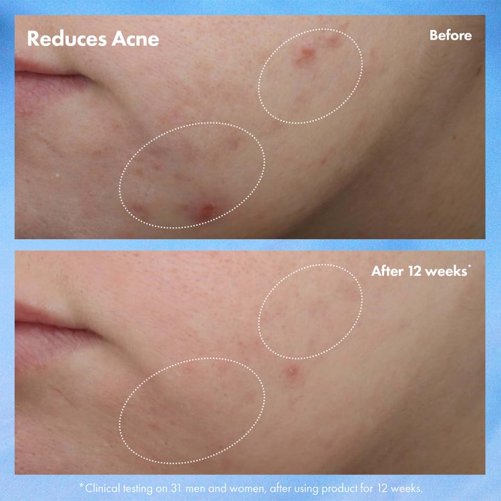 Origins Clear Improvement Blemish Clearing Hydrating Lotion 50 ml kasvovoide vähentää aknea 12 viikon käytön jälkeen.