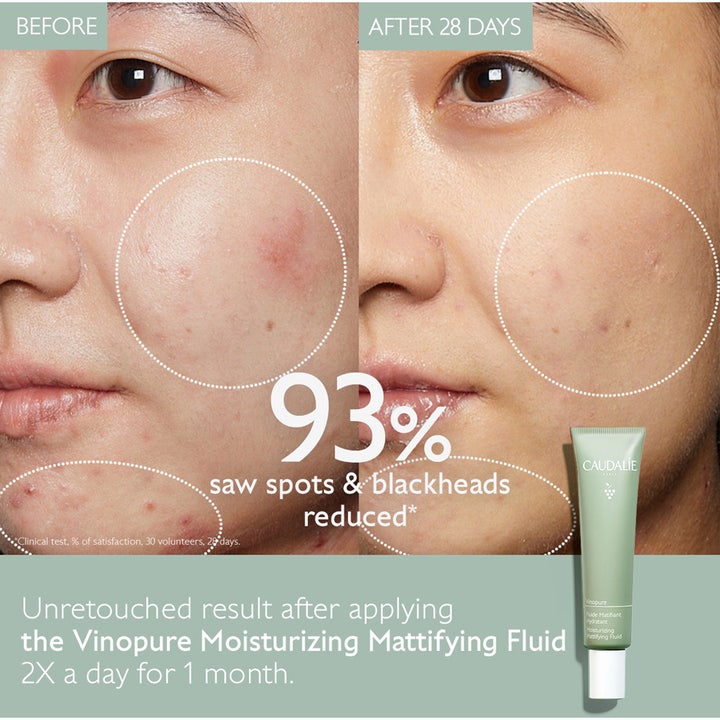 Caudalie Vinopure Moisturizing Mattifying Fluid 40 ml kasvovoide vähentää epäpuhtauksia ennen ja jälkeen -kuvassa.