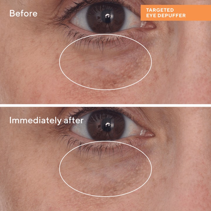 Murad Targeted Eye Depuffer 15 ml silmänympärysvoide ennen ja jälkeen kuva vähentää turvotusta silmien alla