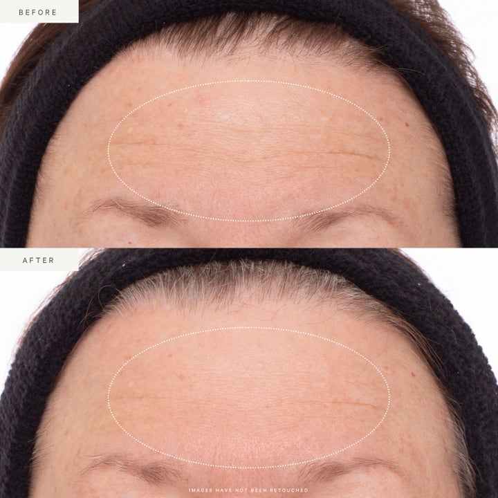 KORA Organics Plant Stem Cell Retinol Alternative Serum 30 ml silottaa otsan juonteita ennen ja jälkeen kuvassa.