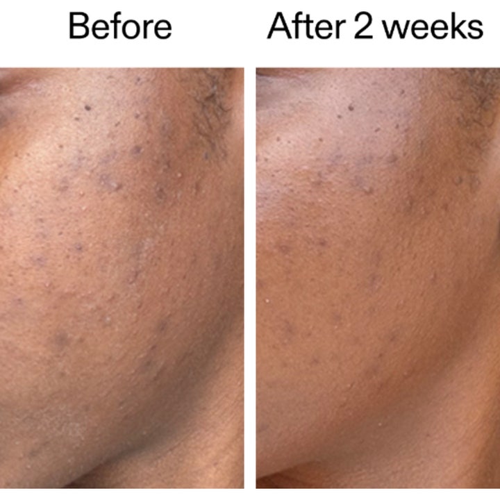 The INKEY List 360 Skin Clearing Serum 30 ml puhdistava seerumi ennen ja jälkeen kuvassa kahden viikon käytön jälkeen.