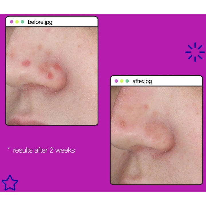 Dermalogica Post-Breakout Fix 15 ml seerumi häivyttää epäpuhtauksia ennen ja jälkeen tuloskuvissa kahdessa viikossa.