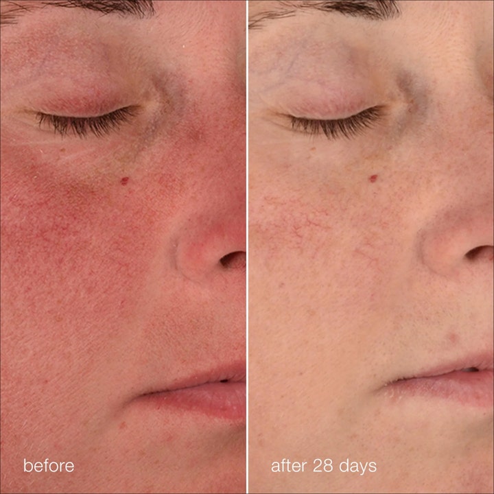 Dermalogica Stabilizing Repair Cream 50 ml rauhoittava kasvovoide vähentää punoitusta ennen ja jälkeen 28 päivän käytön.