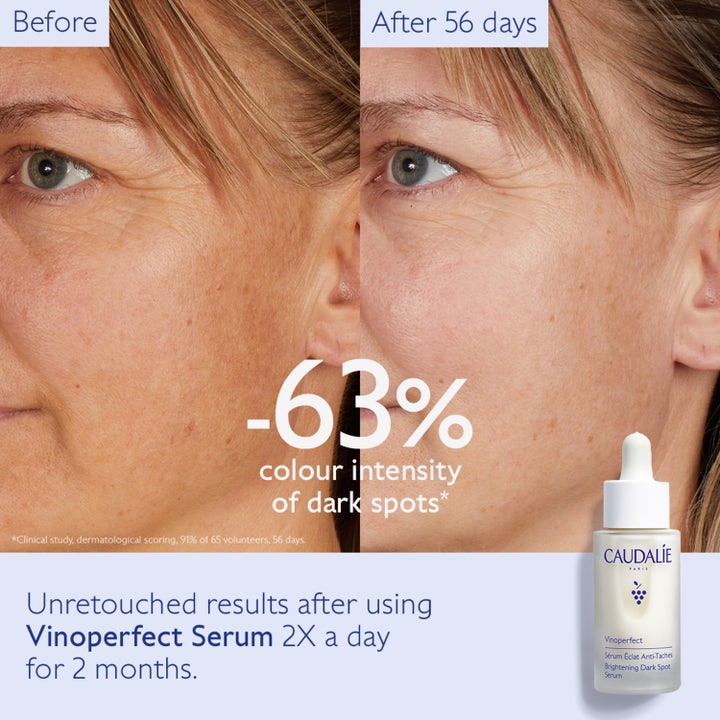 Caudalie Vinoperfect Radiance Serum 30 ml kirkastava seerumi pigmenttiläiskiä vastaan ennen ja jälkeen -kuvassa.