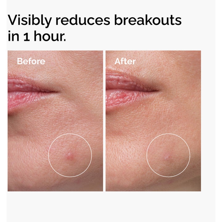 The Ordinary Sulfur 10% Masque 5 g täsmähoito näyttää ennen ja jälkeen kuvilla miten epäpuhtaudet vähenevät.