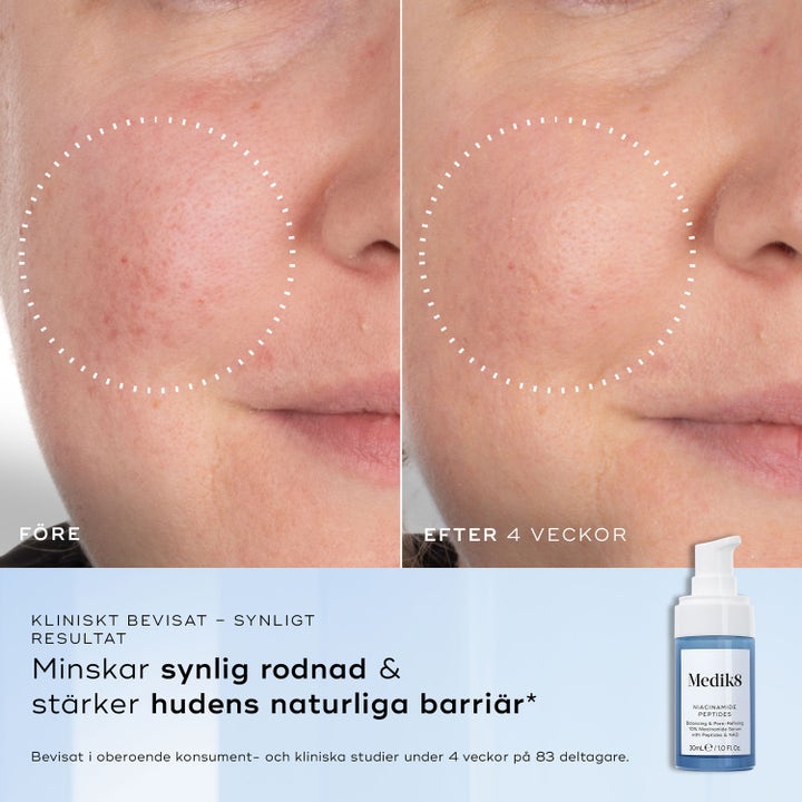 Medik8 Niacinamide Peptides 30 ml kasvovesi vähentää punoitusta iholla ennen ja jälkeen 4 viikon käytön.